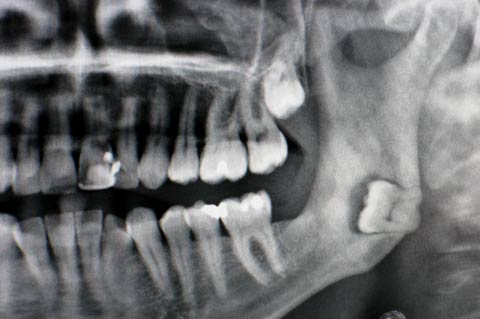 Impacted Teeth