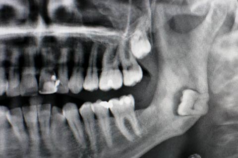 impacted tooth
