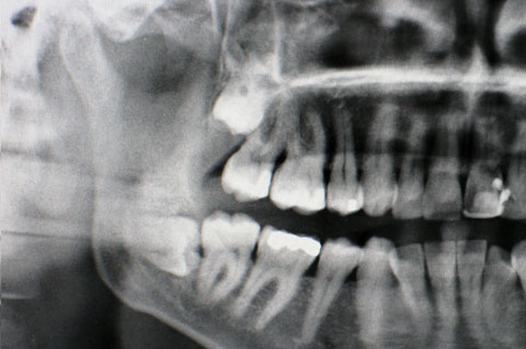 Impacted Teeth