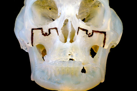 Jaw Deformity