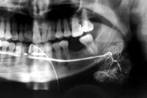 Salivary Gland Disorders